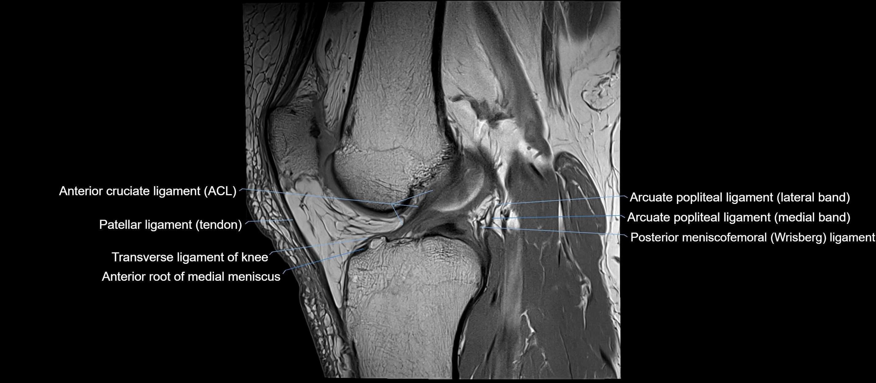 MRI sagittal  ligaments cross sectional anatomy 3T  radiology  image-img-00001-00027.webp